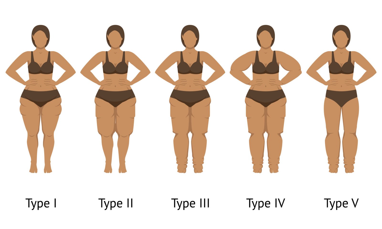 An image depicting the various stages of lipedema.
