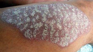 An image of plaque psoriasis on the arm.