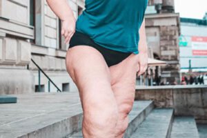 A woman with lipedema in her legs