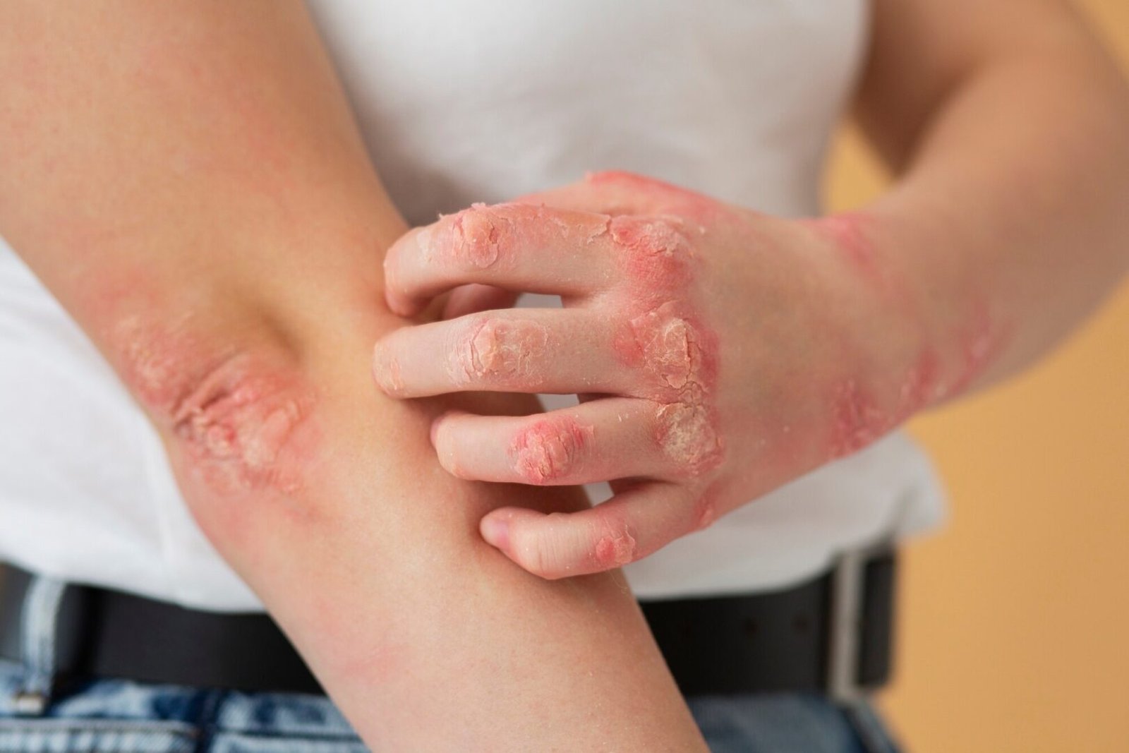 An image of a person with plaque psoriasis on their hand and elbow. The keto diet can help.
