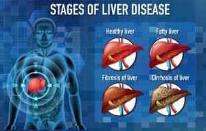 An illustration of the stages of liver disease