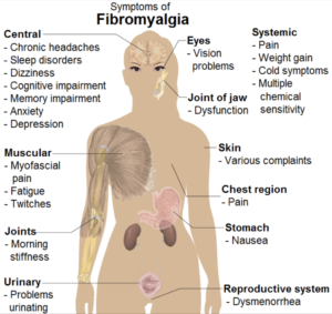 A graphic of fibromyalgia symptoms