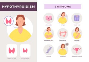 An infographic depicting hypothyroid symptoms caused by Hashimoto's disease.