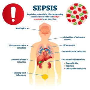 A graphic depicting the causes of sepsis in the human body.